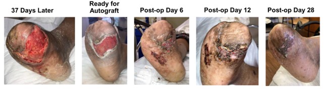 foot gas gangrene wound split thickness graft