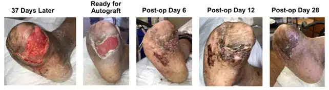 foot gas gangrene wound split thickness graft
