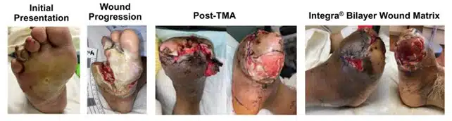 foot gas gangrene wound
