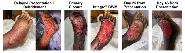 foot necrotizing fasciitis wound