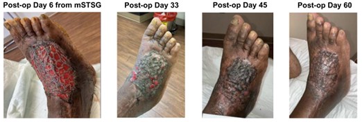 foot nectrotizing fasciitis wound outcome after recell