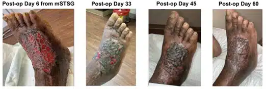 foot nectrotizing fasciitis wound outcome after recell