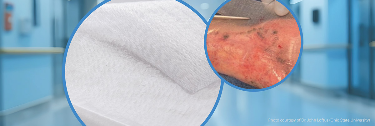 moist wound healing in acute wound management using a temporary biosynthetic wound matrix