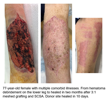 Autologous skin cell suspension (SCSA) treatment of hematoma debridement on the lower leg after 3:1 meshed grafting and SCSA.
