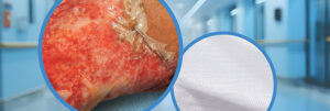 PermeaDerm alternative to allograft