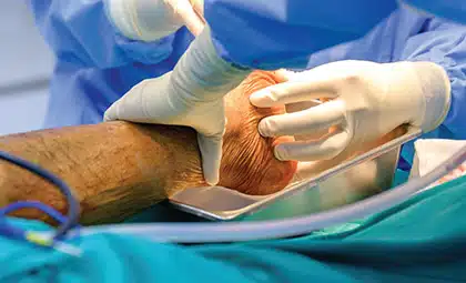 Achieving Closure of Nonthermal Full-Thickness Lower Extremity Wounds